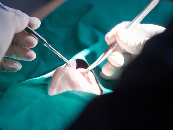 자리를 잡은 뼈에 임플란트를 심는 수술 장면