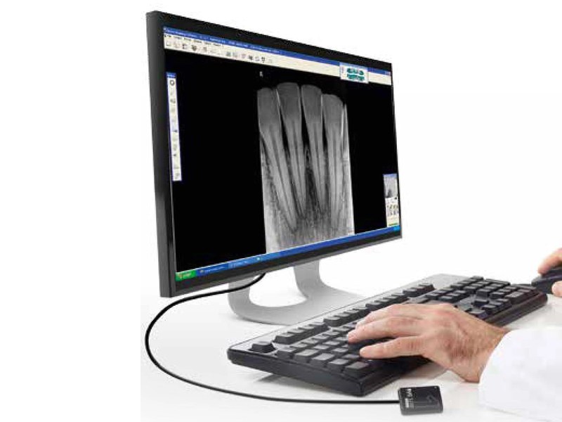 Carestream RVG 5200 디지털 센서와 촬영 영상을 띄운 모니터