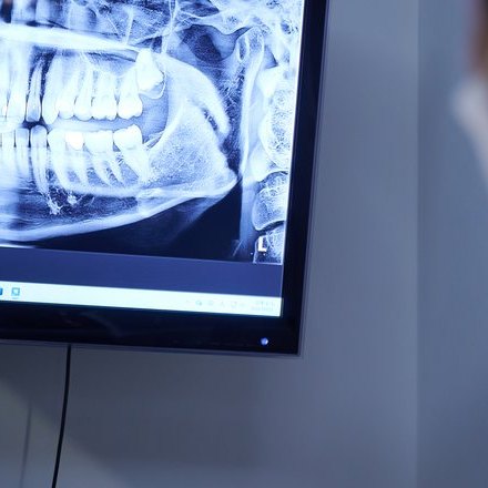 파노라마 화면으로 임플란트 상태를 확인하는 장면