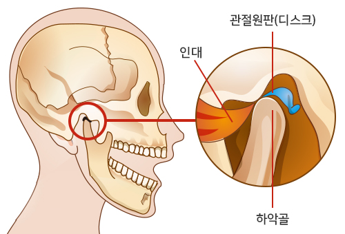 비정상적인 턱관절 도해